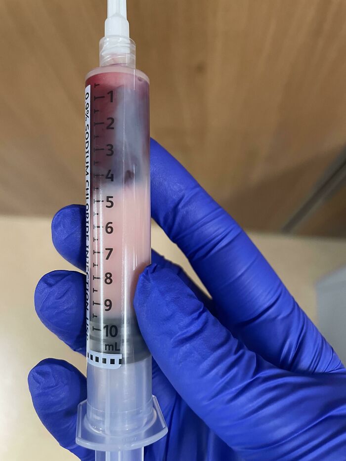 Blood Sample From My Patient With Hypertriglyceridemia