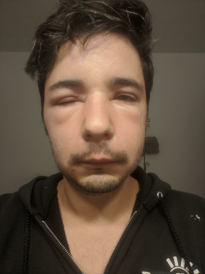 I Was Stung Twice, Once On My Forehead And Once On The Top Of My Ear