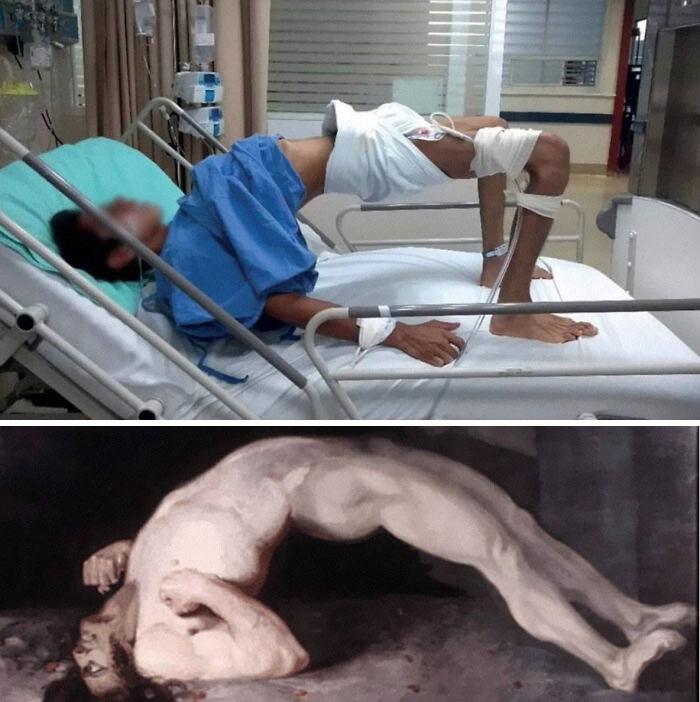 Case Study Of Tetanus In An Unvaccinated Child