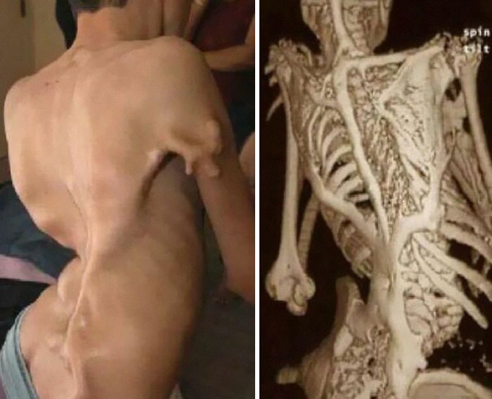 Case Of Fibrodysplasia Ossificans Progressiva