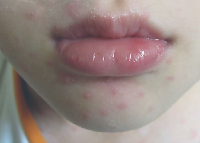 Close-up of a person’s lips and chin with skin irritation, illustrating challenges Disney theme park employees reveal.