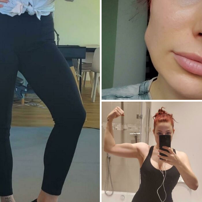 I Have Muscle Hypertrophy (Muscles Grow Big Without Excersize). I Got Botox In My Jaw Yesterday Because Of This