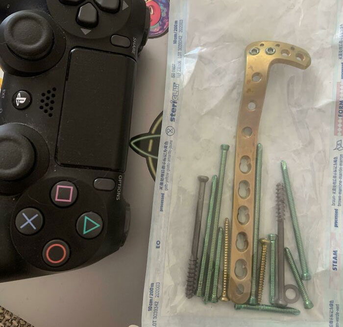 This Implant And Screws That Came Out Of My Knee...