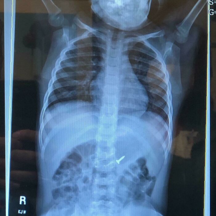 "Can’t Wait For 2020 To Be Over" They Said. They Obviously Never Met My Kid Who Decides To Swallow A Screw To "Transform" Into Optimus Prime