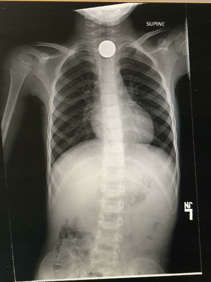 Son Decided To Swallow A Nickel And Turn $.05 Into $4400.00