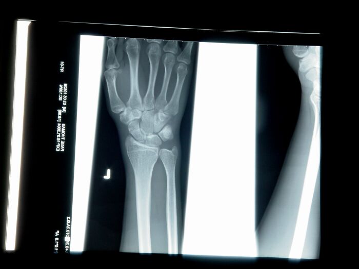 X-ray image of a forearm and wrist, illustrating evidence discussed by lawyers in this online group sharing stories.