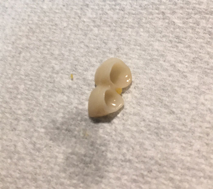 Lost The Crown Off My Front Right Teeth, On A Sunday, On Christmas Week, In The Middle Of A Pandemic