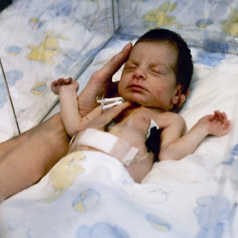 On This Day In 1984, The First Baboon To Human Heart Transplant Is Performed. 2 Week Old “Baby Fae” Had A Defective Heart Where Parts Of The Left Side Of The Heart Were Missing. A Few Days After The Baby’s Birth, Dr. Bailey Convinced The Mother To Try An Experimental Baboon Heart Transplant Since Baby Fae’s Chance Of Survival Was Close To None. Sadly, The Transplant Was Not Able To Save The Baby’s Life As The Baby Passed Away Twenty Days Later.