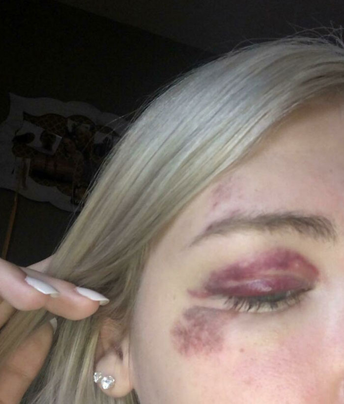 Randomly Fainted And Fell Face First Onto A Concrete Floor. Merry Christmas