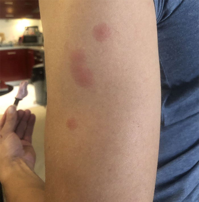 Traje chinches a casa de una estadía en Airbnb