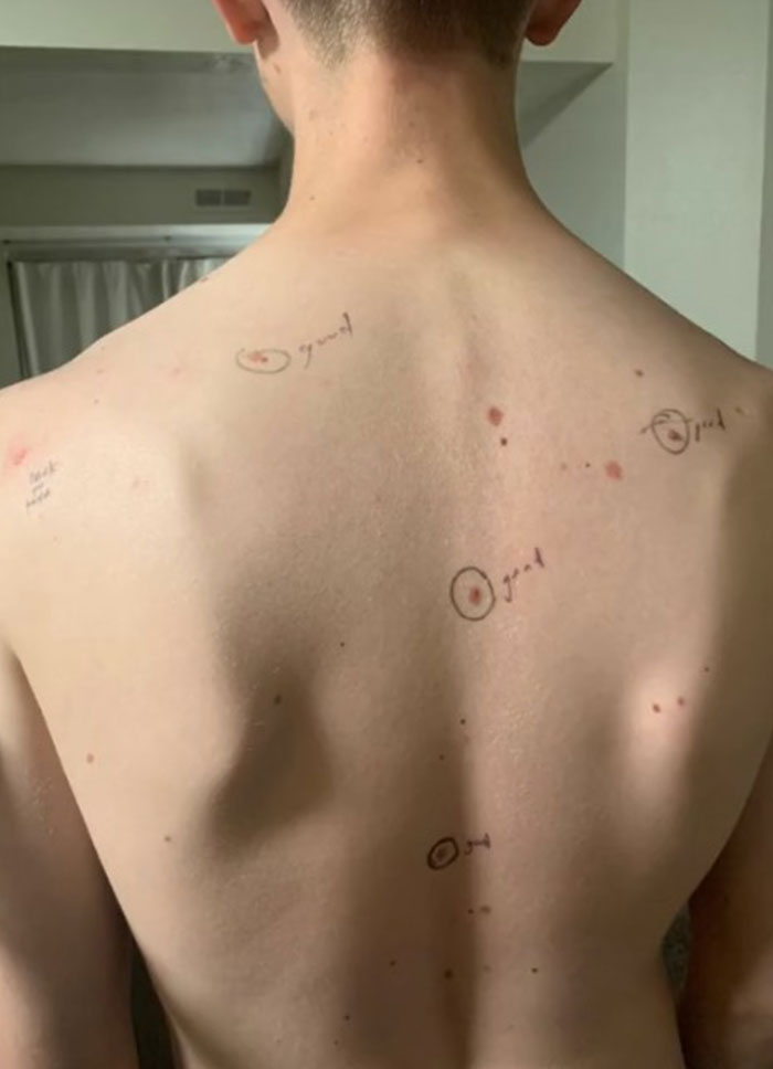 Wife Circled Her Husband's Moles Before He Went To The Doctor, He Came Back With Notes On His Body