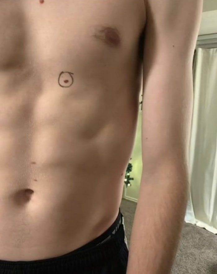 Wife Circled Her Husband's Moles Before He Went To The Doctor, He Came Back With Notes On His Body