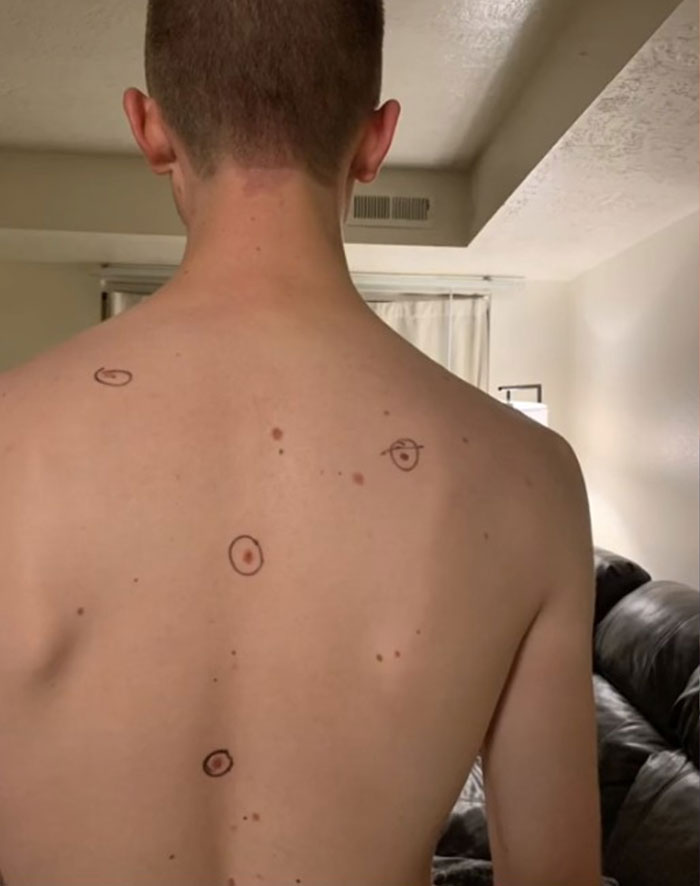 Wife Circled Her Husband's Moles Before He Went To The Doctor, He Came Back With Notes On His Body