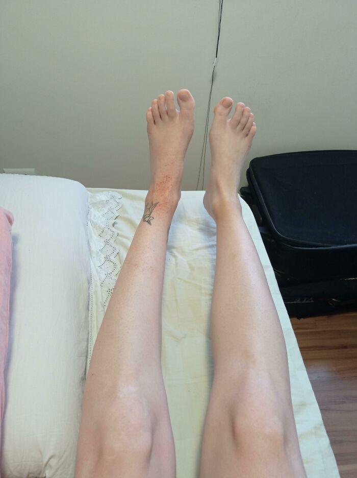 Had Surgery To Repair My Left Achilles Tendon. This Is The Difference Between Both My Legs After Only 3 Weeks Of Not Using The Left One