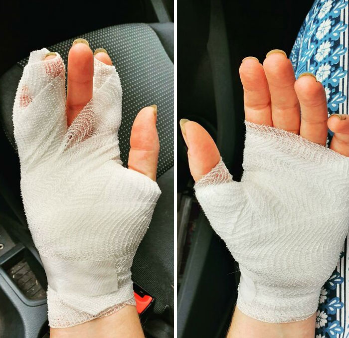 Worked With Concrete Without Gloves. Didn't Know It's Corrosive