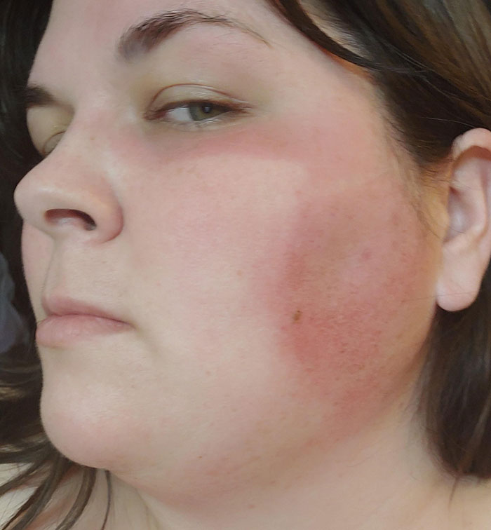 Working An Outdoor Vaccine Clinic. Didn't Think About Sunscreen. Now I Have A Mask-Shaped Sunburn, But Only On Half My Face