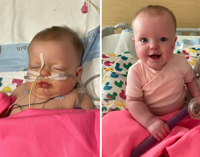 Antes y después: Mi hija luchando contra una combinación de VSR, Rhino enterovirus y neumonía bacteriana. Casi murió, pero ahora está en casa sana y salva