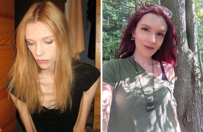 Today, I Am 6 Months Fully Anorexia And Bulimia Free. Recovery Is Possible