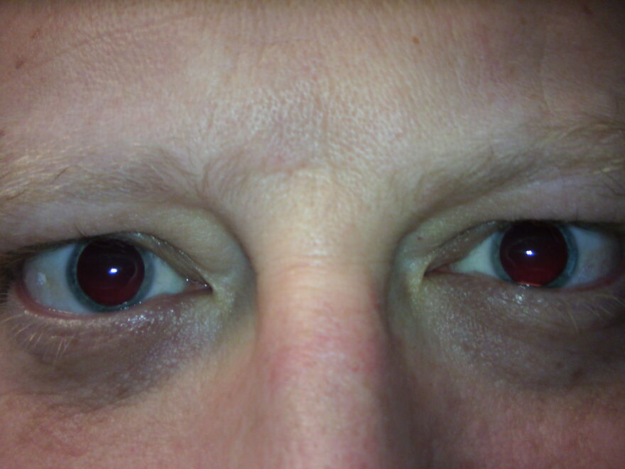 Blue Eyes After A Visit To The Eye Doctor :)