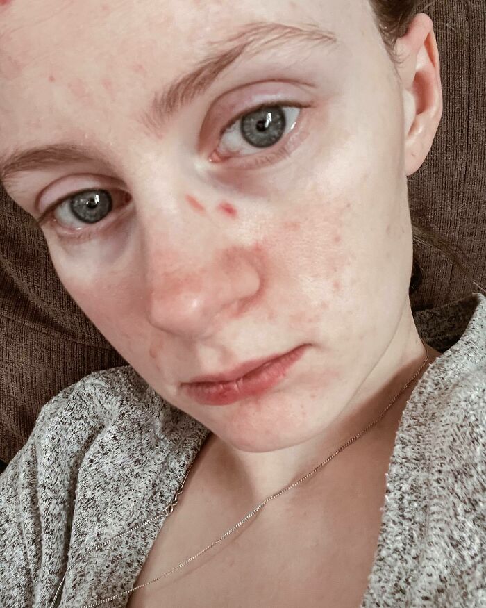 I Am Really Struggling With Dry Skin And Acne This Pregnancy. It Has Been Rough On My Confidence. This Little Peanut Is So Worth All The Rough Things This Pregnancy