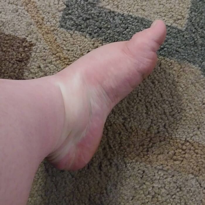 Pregnancy Is Glamorous! Feels Like My Feet Are Gonna Fall Off. Itchy And Painful