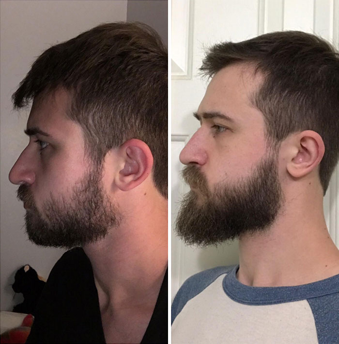 Nature Didn’t Bless Me With A Strong Jawline, So I Grew One Myself