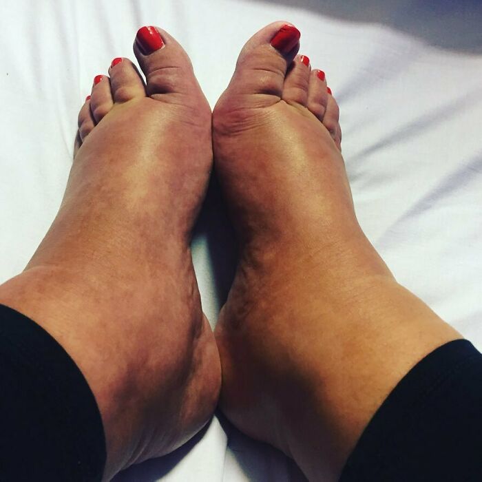 2 Years Ago I Really Had That Twin Pregnancy Glow. With Only A Week To Go My Feet Actually Felt Like They Were Going To Split Open