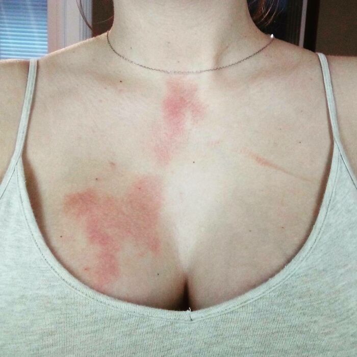 I Apparently Have Forgotten How Mugs Work. This Is What Happens When You Are Pregnant And Make Yourself A Hot Cup Of Tea At 3AM