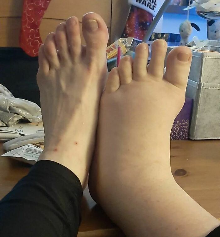 I'd Been Told My Pregnant Wife Would Have Some Major Cankles During The Final Stretch But Wow! Foot On The Left Is Mine (Non-Bio Mom), Right - Bio Mom's Foot