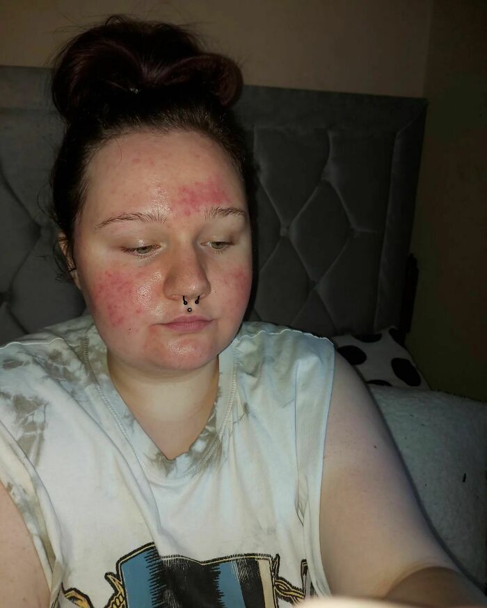 This Pregnancy And My Skin. Wow, What A Rollercoaster