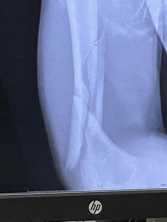 Me rompí y me disloqué el brazo. Feliz cumpleaños a mí