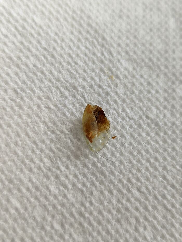 Bought One Of Those Ear Cleaners With A Camera And Just Pulled Out A Contact Lens. I Have No Idea How Long It Was In There