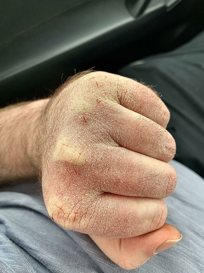 Consequences Of Working In A -10°C Lab Where I Have To Wash My Hands 40 Times A Day