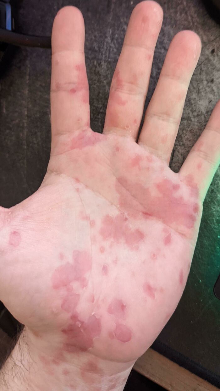 A Few Weeks Ago I Somehow Picked Up A Viral Rash And Now Most Of My Body Looks Like This