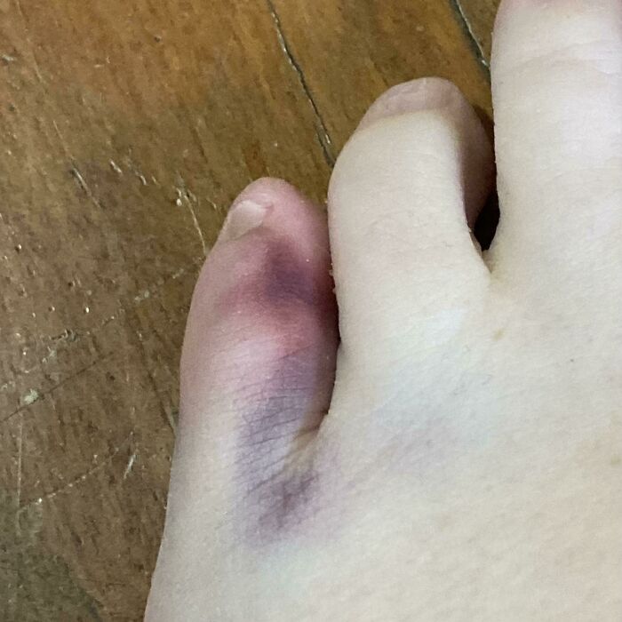 Stubbed My Toe Yesterday. It Hurt This Morning When I Put My Shoes On. Took My Shoes Off This Evening And Found This