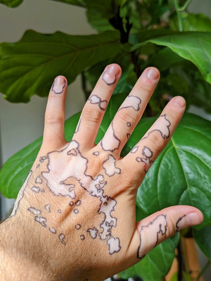 I Traced Around My Vitiligo Spots