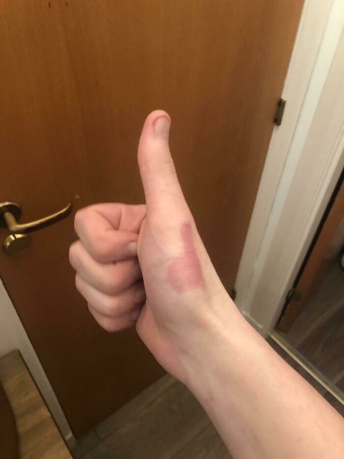 Thumbs Up Burn On A Up Thumb