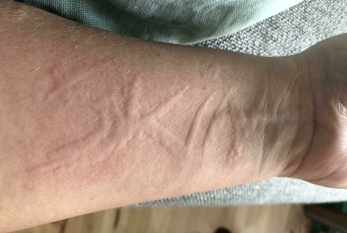 My Skin Raises Where I Trace My Finger Over It