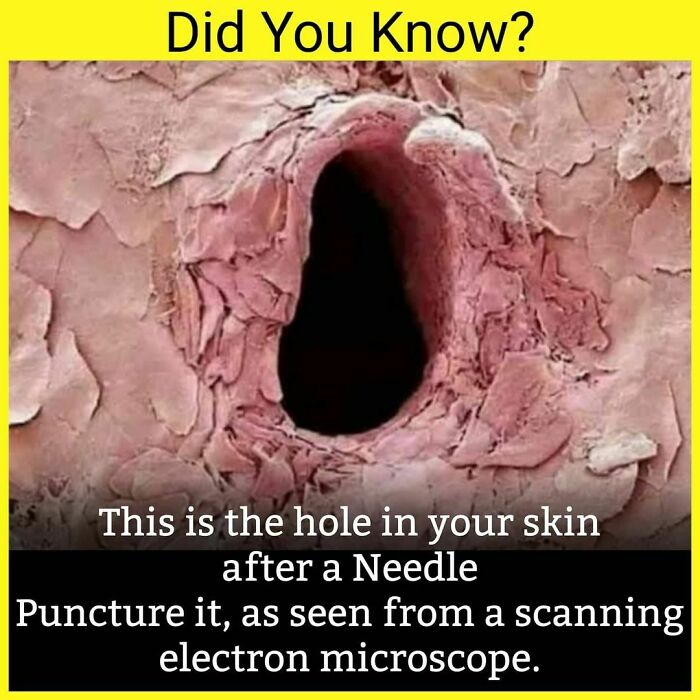 Do You Fear Needles?