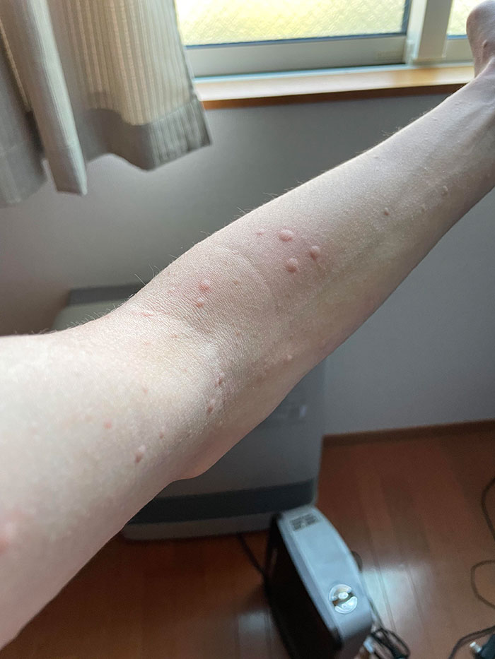 Do You Know When People Ironically Say They’re Allergic To Work? Apparently, I’m Allergic To My Own Sweat