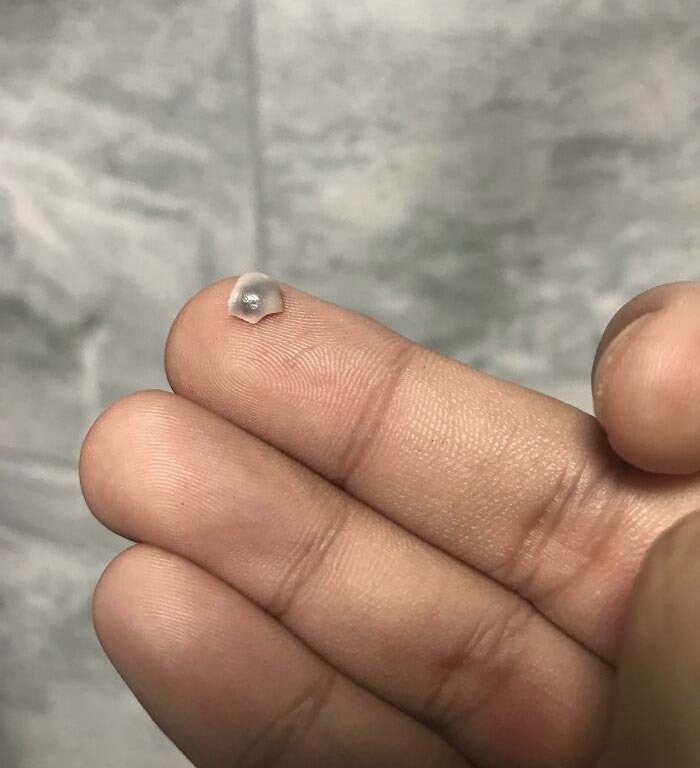 A Piece Of My Infected Wisdom Tooth Just Fell Off