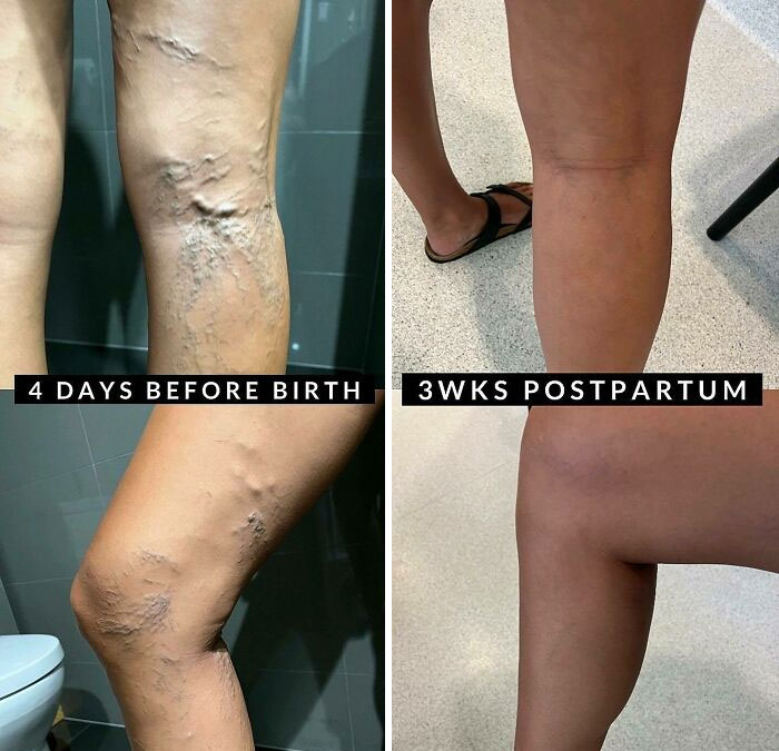 Pregnancy Varicose Veins Are No Fun. Had Them For All Four Pregnancies But They Were The Worst For The Last Pregnancy (With Twins)