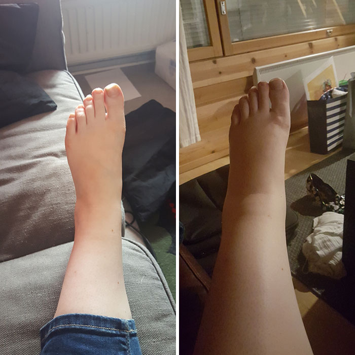 Pregnancy Swelling, It Ain't No Joke