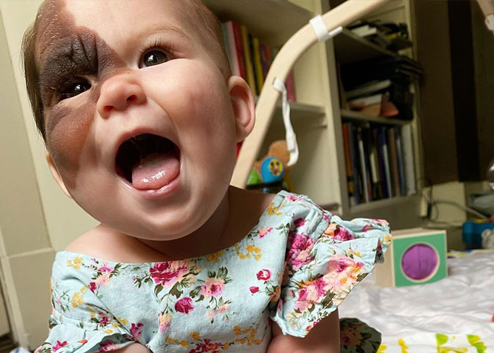 Mom Shares Her Daughter&rsquo;s Unique Birthmark, Gathering 300k Followers Supporting Their Journey