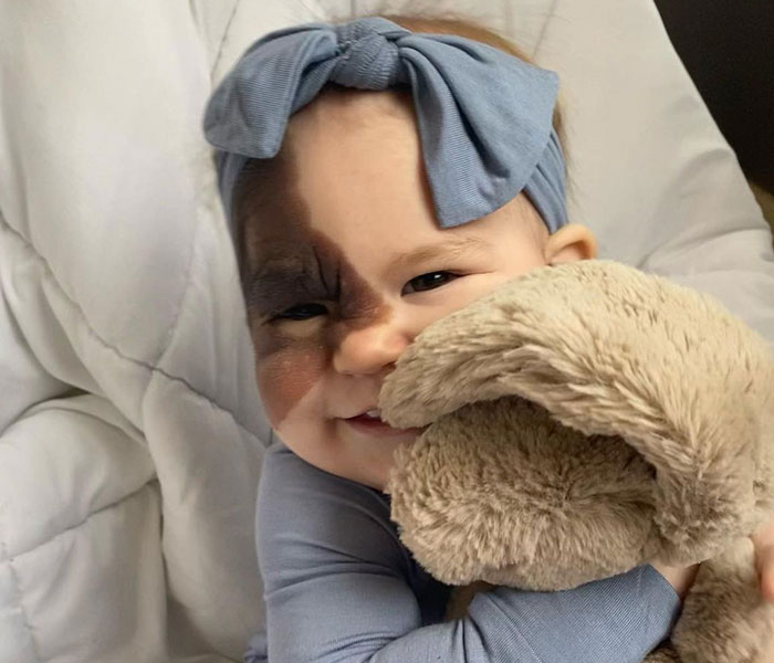 Mom Shares Her Daughter&rsquo;s Unique Birthmark, Gathering 300k Followers Supporting Their Journey