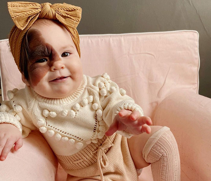 Mom Shares Her Daughter&rsquo;s Unique Birthmark, Gathering 300k Followers Supporting Their Journey