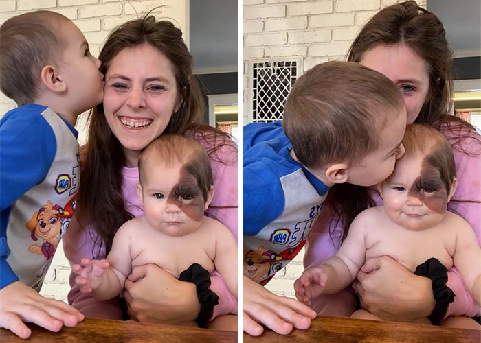 Mom Shares Her Daughter&rsquo;s Unique Birthmark, Gathering 300k Followers Supporting Their Journey