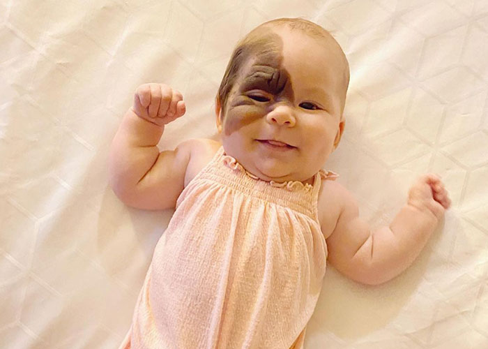 Mom Shares Her Daughter&rsquo;s Unique Birthmark, Gathering 300k Followers Supporting Their Journey