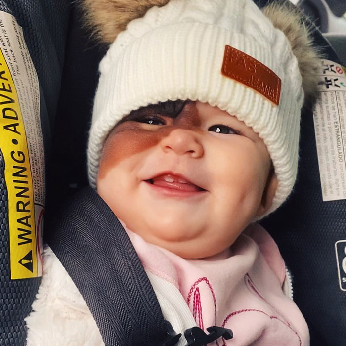 Mom Shares Her Daughter&rsquo;s Unique Birthmark, Gathering 300k Followers Supporting Their Journey