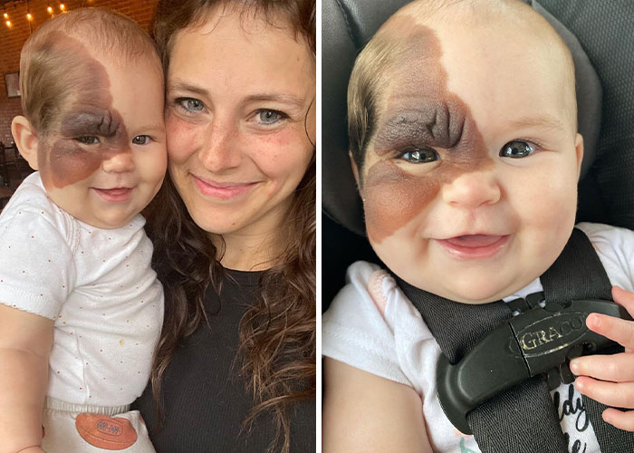 Mom Shares Her Daughter’s Unique Birthmark, Gathering 300k Followers Supporting Their Journey